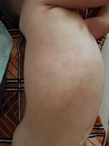 Сыпь