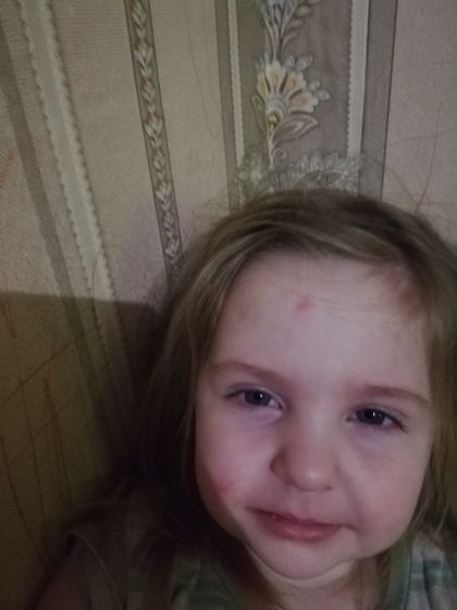 Что это за прыщи???