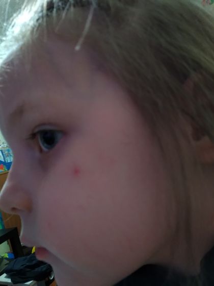 Не проходит уже несколько лет. Что то на щеке