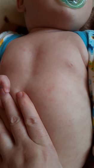 Ветрянка или аллергия?