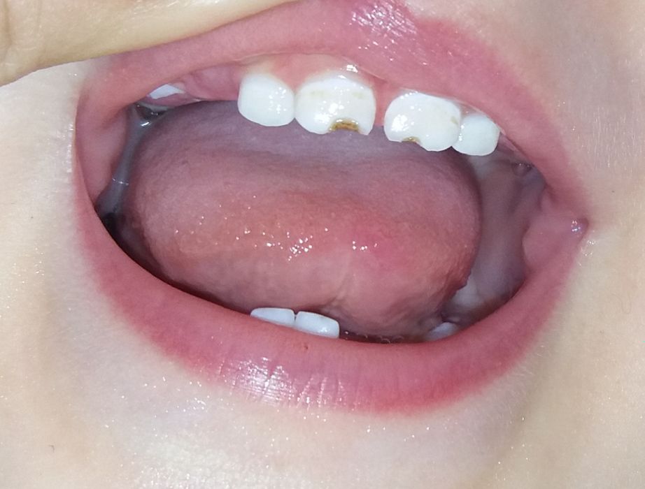 Кариес ночного вскармливпния! есть тут стоматологи детские ?