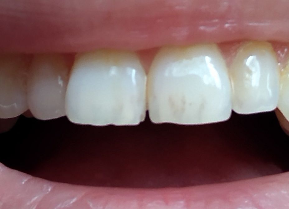 Передние зубы