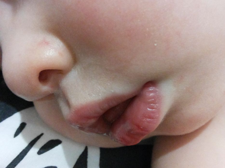 Сохнут губы у ребёнка