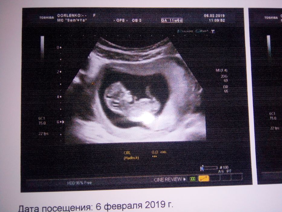 Первое УЗИ второго малыша. 11,6 недель.