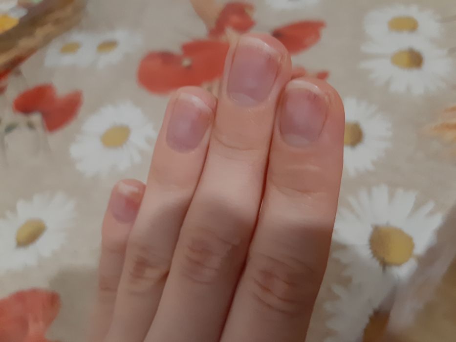 Проблемы с ногтями